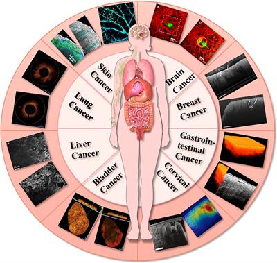 Research progress on the application of optical coherence tomography in the field of oncology